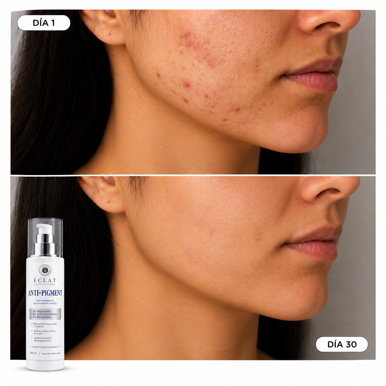 ÉCLAT® | Emulsión Facial Anti-Pigment Dermocosmética para Manchas Hormonales, Solares y de Acné